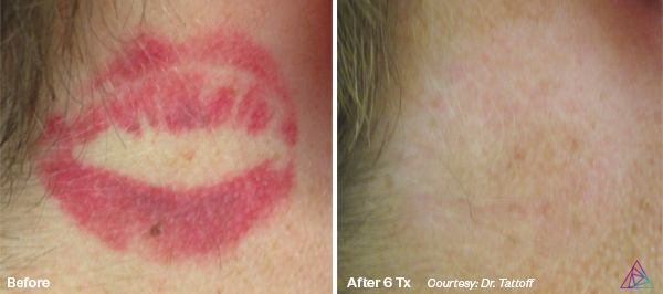Before and after tattoo removal
